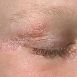 Example of psoriasis
